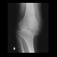 Gonarthrosis, severe: X-ray - Plain radiograph